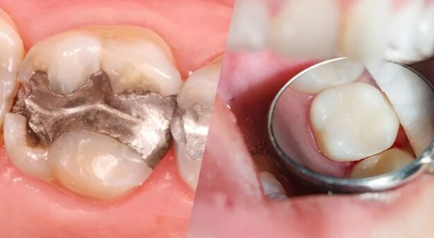 composite fillings treatment