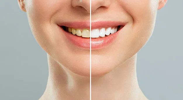 woman teeth-before after whitening white background