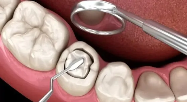 Composite Fillings in Aberdeen