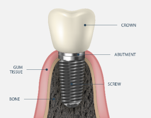 part of dental implants