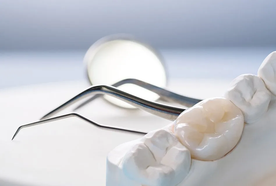 Inlays & Onlays treatment