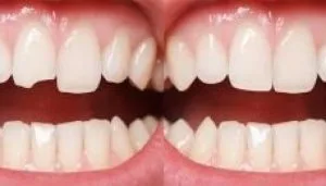 Composite Bonding