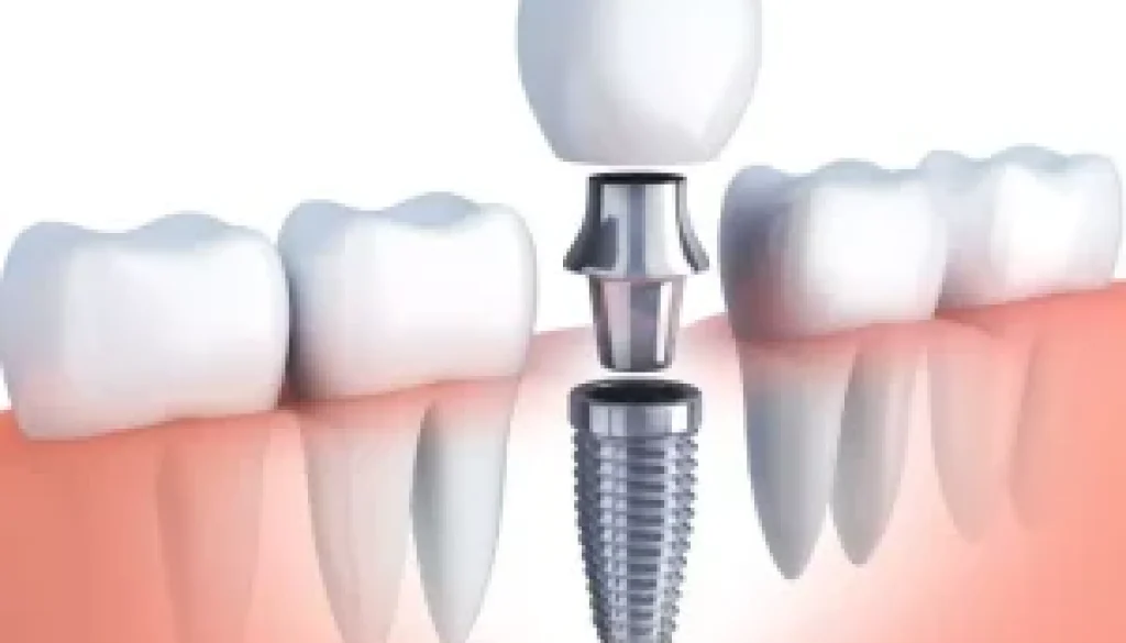 dental implant