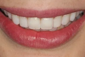 Composite Bonding