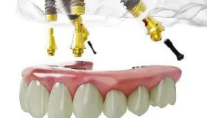 All on 4 Dental Implants