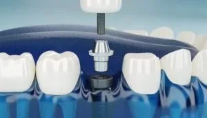 Dental Implants