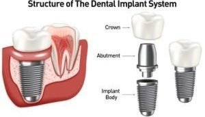 dental implants