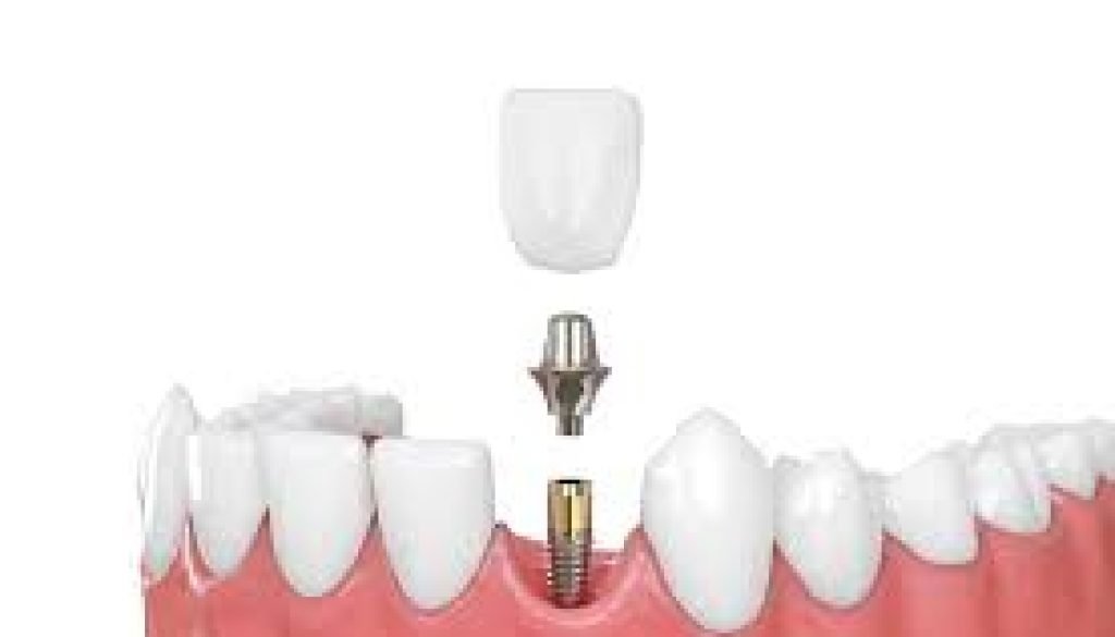 how long before dental implants feel normal