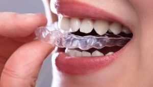 invisalign