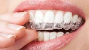 Invisalign Treatment