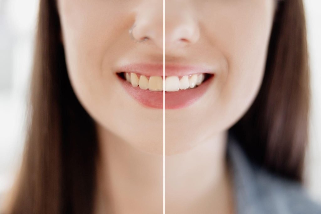 Teeth Whitening 101: How It Works in Bridge Street and What You Need to Know