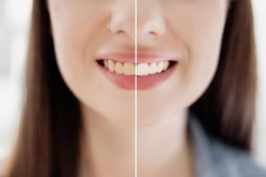 Teeth Whitening 101: How It Works in Bridge Street and What You Need to Know