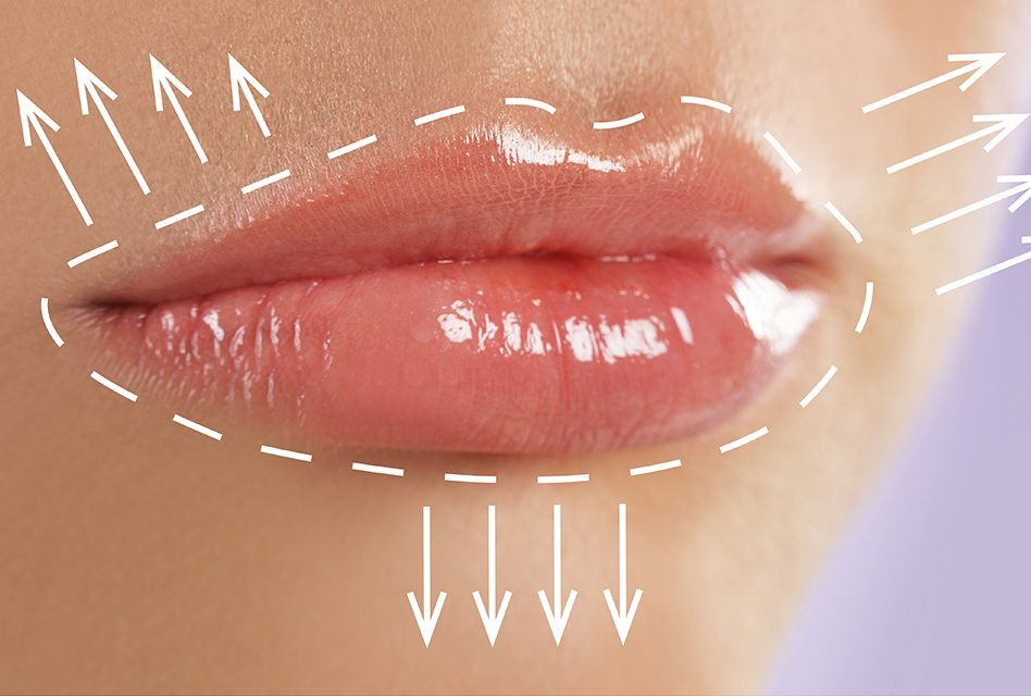 Lip Augmentation Treatment!