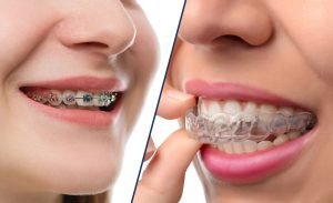 is invisalign better than braces