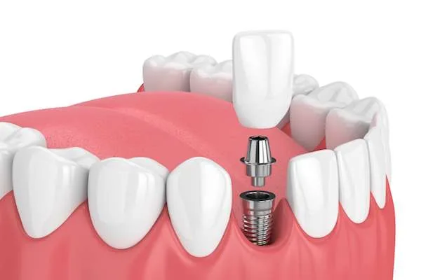 Are tooth implants painful?
