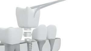 dentures vs. dental implants