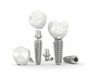 Dental Implants