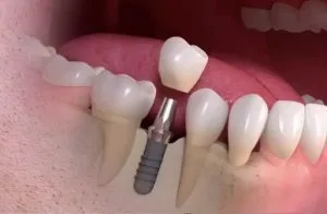 dental imlant