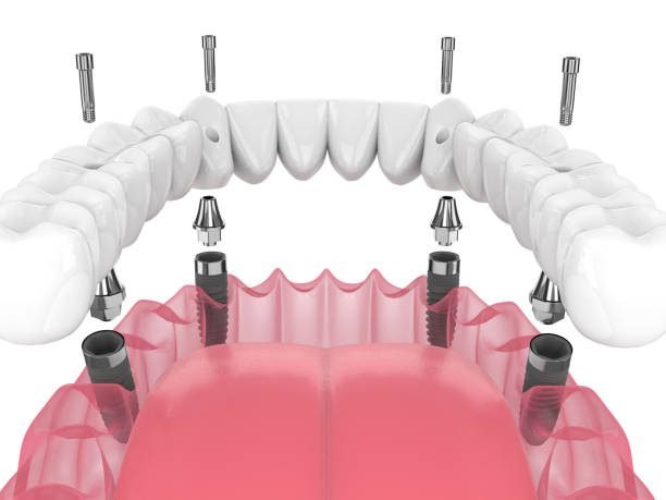 All-on-4 Dental Implants