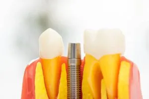 Dental Implants