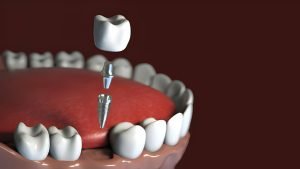 Dental implants treatment
