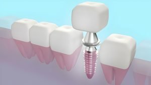 Gums Are Strong Enough for Implants