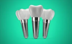 same-day dental implants