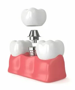 Dental Implants