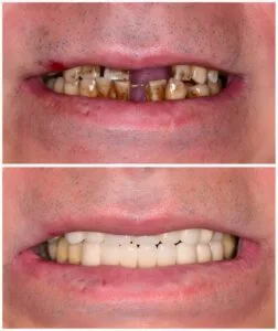 Dental implant Aberdeen