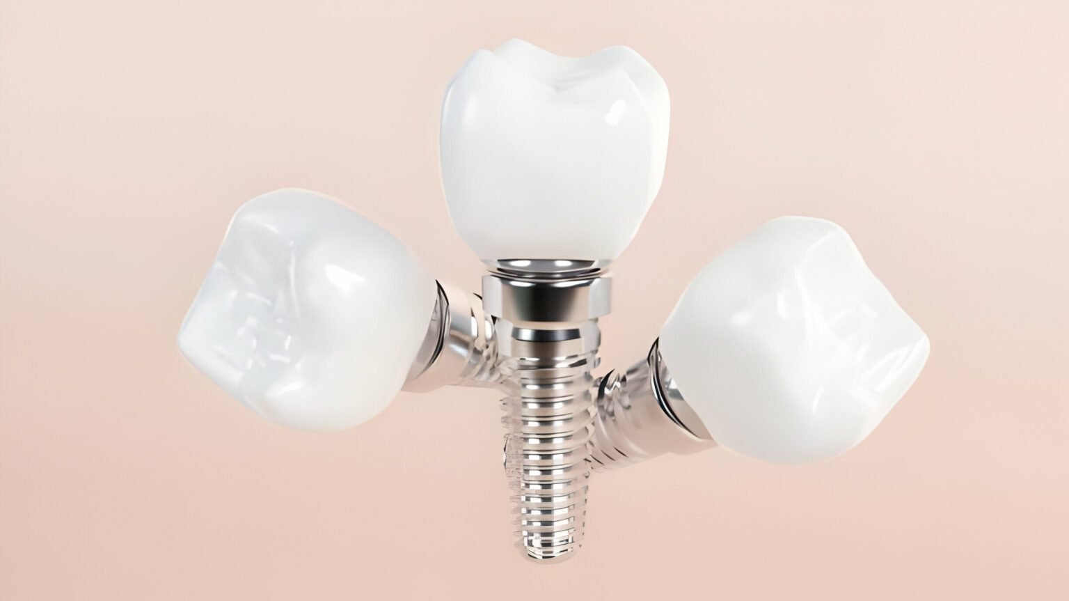 Can a Dental Implant Be Removed and Replaced?