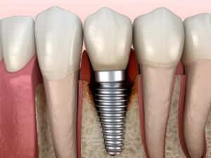 peri-implantitis at home