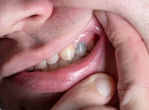 Can a Dead Tooth Stay in Your Mouth