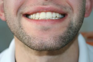 Grind Your Teeth for Bonding