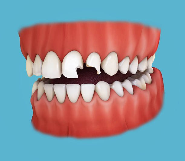 Composite Bonding