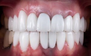 composite bonding can be whitened