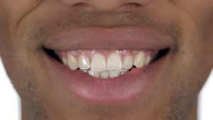 How to get rid of stains on composite bonding?