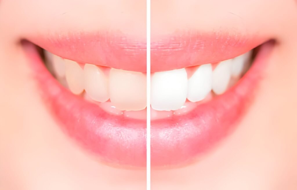 Teeth Whitening