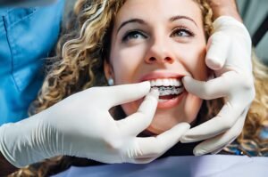 process for getting Invisalign® in Aberdeen